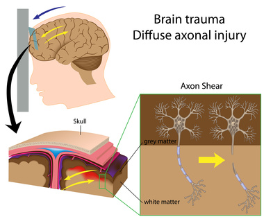 Traumatic Brain Injury